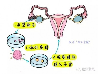 什么是试管婴儿？试管婴儿流程过程