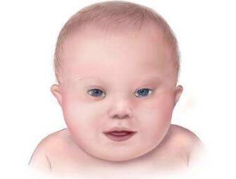 唐氏儿：唐氏综合症的宝宝有什么症状