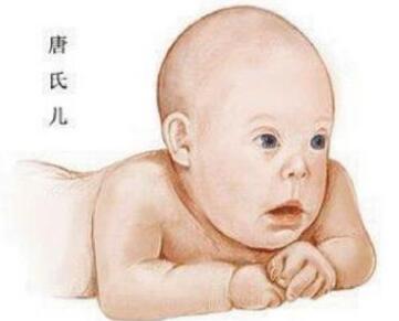 唐氏儿：唐氏综合症的宝宝有什么症状