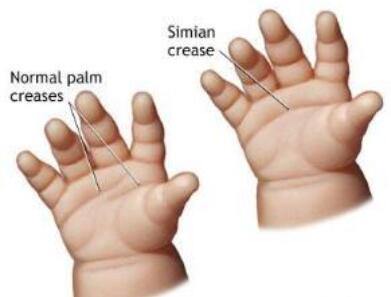 唐氏儿：唐氏综合症的宝宝有什么症状