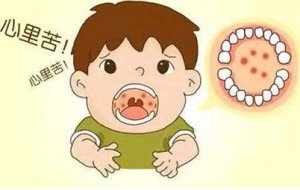 疱疹性咽峡炎是什么