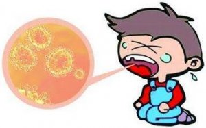 疱疹性咽峡炎症状