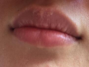 嘴唇上有小白点颗粒状怎么回事？