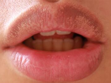 嘴唇上有小白点颗粒状怎么回事？