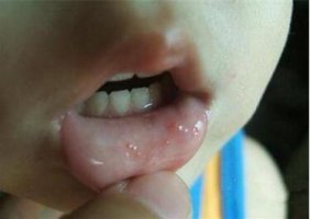 手足口病初期症状图片 教你辨别手足口病潜伏期