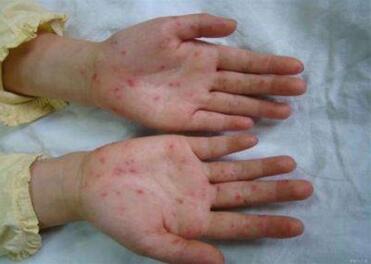 手足口病初期症状图 教你辨别手足口病潜伏期