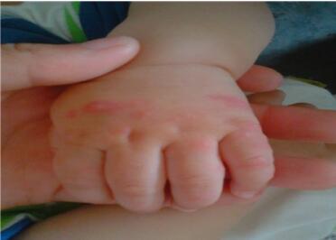 手足口病初期症状图 教你辨别手足口病潜伏期