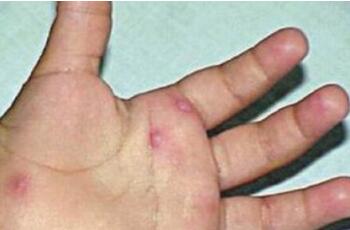 小儿手足口病初期症状_小儿手足口最早期图片