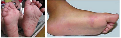 小儿手足口病初期症状_小儿手足口最早期图片