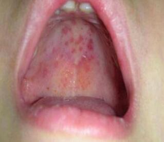 小儿手足口病初期症状_小儿手足口最早期图片