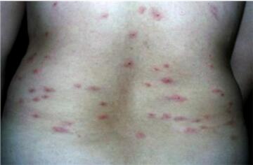 什么样的红点是艾滋病