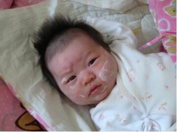 新生儿湿疹可以用炉甘石洗剂吗