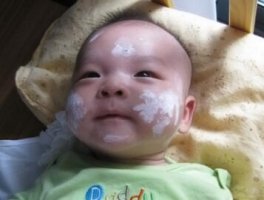 新生儿湿疹可以用炉甘石洗剂吗
