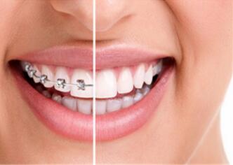 带牙套的年龄_牙套要带多久