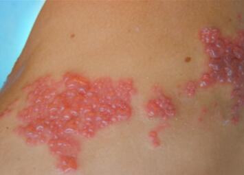 带状疱疹传染吗？带状疱疹怎么治疗