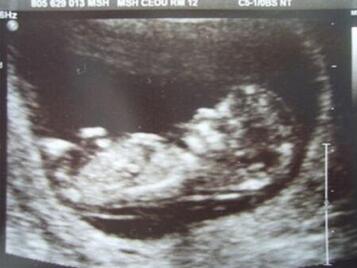 NT检查看男女 其方法和准确性你都了解吗