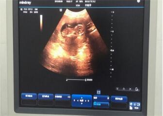 双顶径股骨长看男女