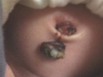 新生儿肚脐护理可以用双氧水消毒吗