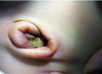 新生儿肚脐发炎症状有哪些？新生儿脐炎怎么办？