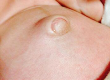 新生儿肚脐发炎症状有哪些？新生儿脐炎怎么办？