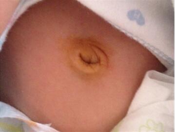 新生儿肚脐发炎症状有哪些？新生儿脐炎怎么办？