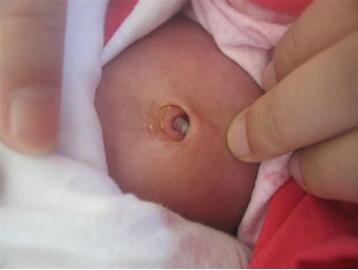 新生儿肚脐发炎症状有哪些？新生儿脐炎怎么办？