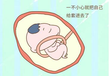 胎儿脐带绕颈怎么办？脐带绕颈能顺产吗