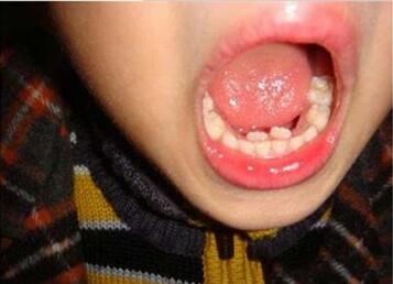 儿童乳牙滞留怎么办