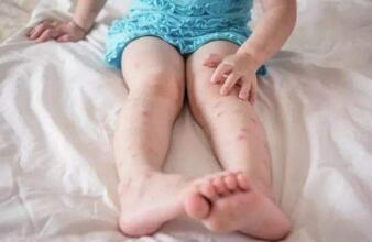 登革热的早期症状