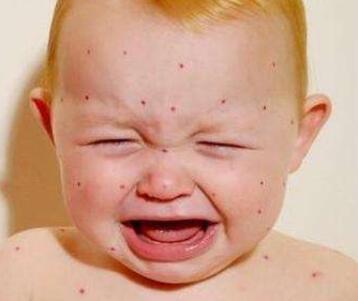 登革热的早期症状