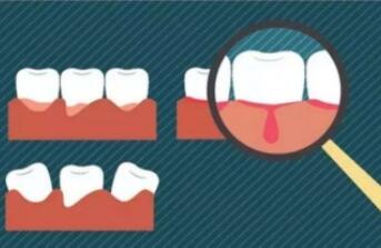 登革热的早期症状