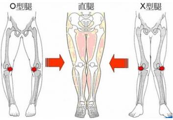 罗圈腿遗传吗？o型腿怎么矫正