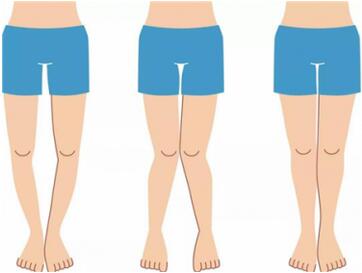 罗圈腿遗传吗？o型腿怎么矫正