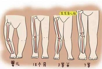 罗圈腿遗传吗？o型腿怎么矫正