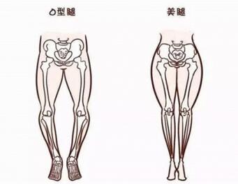 罗圈腿遗传吗？o型腿怎么矫正