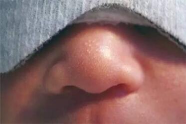 宝宝常见10大皮肤问题及护理心得