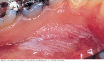 婴儿鹅口疮症状有哪些