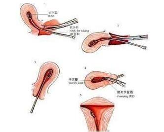 取环手术是怎么取的？取环后注意事项