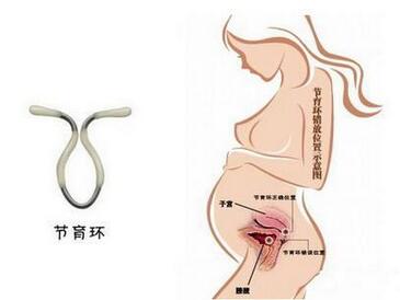 取环手术是怎么取的？取环后注意事项