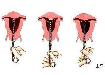 取环手术是怎么取的？取环后注意事项