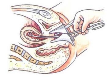 取环手术是怎么取的？取环后注意事项