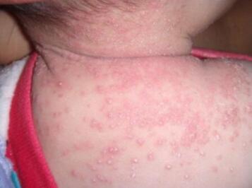 新生儿脓疱疮病是怎么引起的