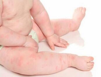 新生儿脓疱疮病是怎么引起的