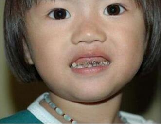 儿童龋齿怎么治疗方法