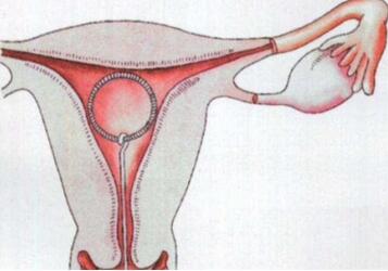 节育环的种类有几种