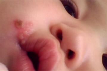 烂嘴角是怎么回事 什么原因