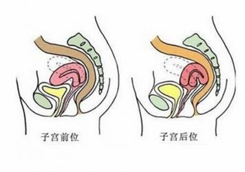 子宫后位如何受孕
