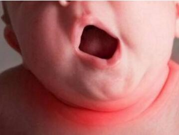 宝宝嗓子有痰咳不出怎么排出