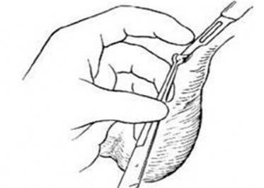 结扎可以解扎吗