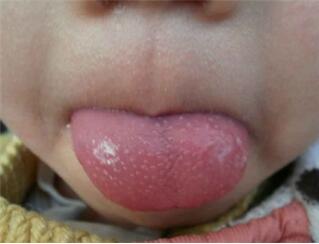 小孩草莓舌是怎么回事？